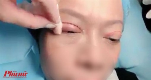 Nhân viên thẩm mỹ viện bị biến chứng do đưa mặt cho chủ tiệm ‘đập đi xây lại’