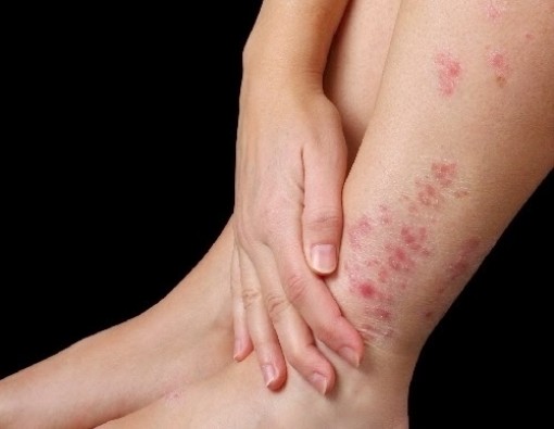 Ngứa dưới da có nguy hiểm không?