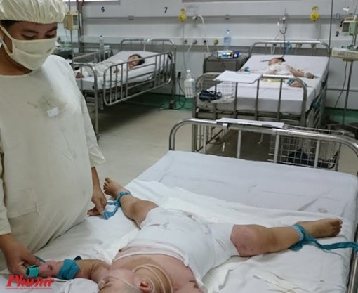 Trẻ phỏng ngày tết, nỗi đau kéo dài đến nhiều năm sau