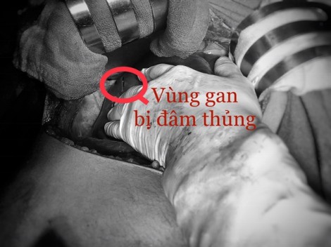 Cứu sống nam thanh niên bị đâm rách gan và tim