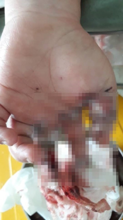 Hai bé trai nát bàn tay do lượm pháo lúc đi chúc tết