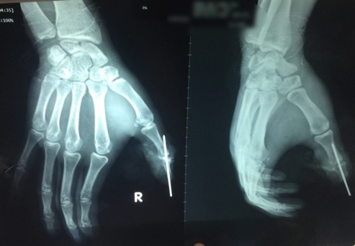 Dây điện ngoài đường cuốn khiến nạn nhân đứt lìa ngón tay cái