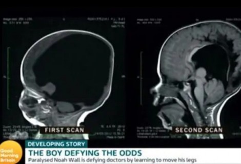 Sinh ra với bộ não chỉ có 2% khối lượng, cậu bé vẫn khỏe mạnh sau 6 năm