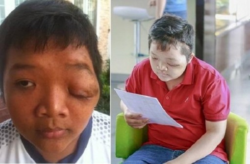 Chuyên gia thần kinh McKay McKinnon phẫu thuật cho trẻ bị u sợi thần kinh