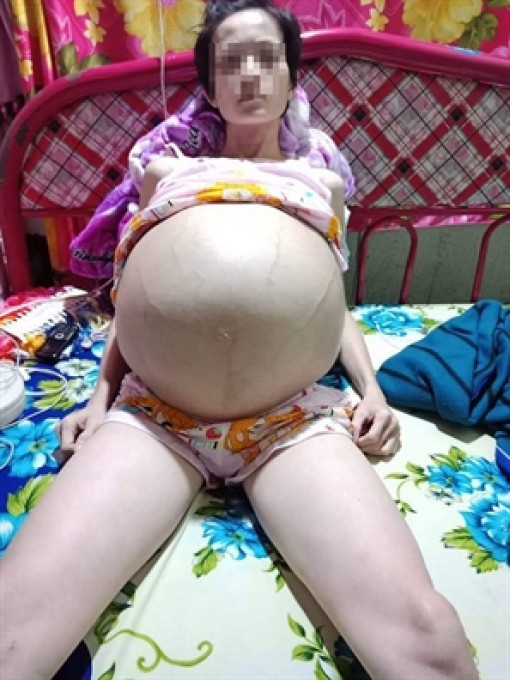 Tưởng có bầu, hóa ra ung thư buồng trứng