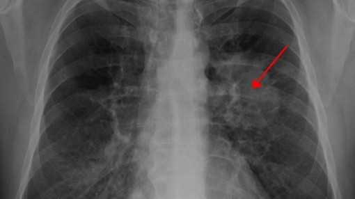 Vắc xin cho bệnh nhân đã bị ung thư phổi giá 1 USD được lưu hành nhiều nước