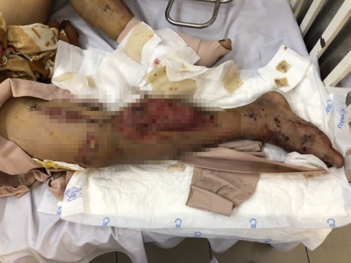 Bác sĩ cứu nam thanh niên không rõ lai lịch bị xe container cán