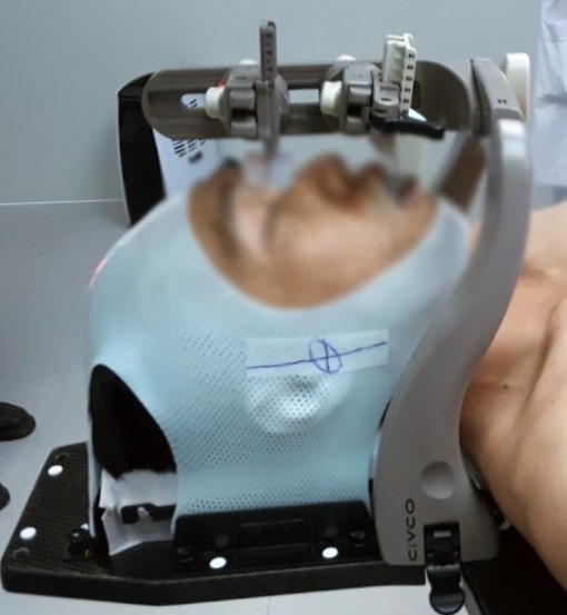 TP.HCM lần đầu tiên xạ trị 6 tia thay vì vài chục tia cho bệnh nhân ung thư