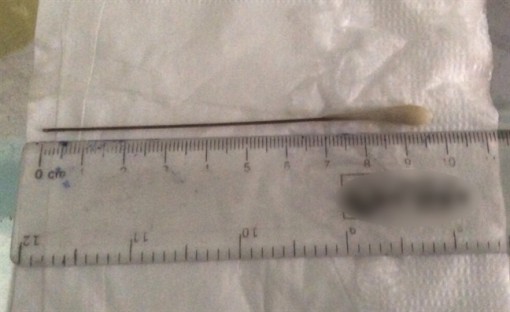 Gắp tăm bông nằm trong phổi của bệnh nhân