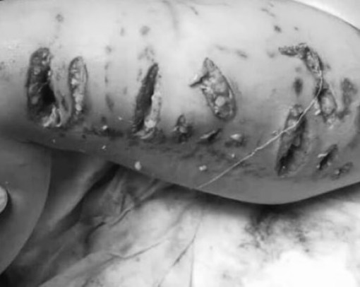 Chó pitbull nhà hàng xóm giằng đứt xích cắn nát đùi bé gái 3 tuổi