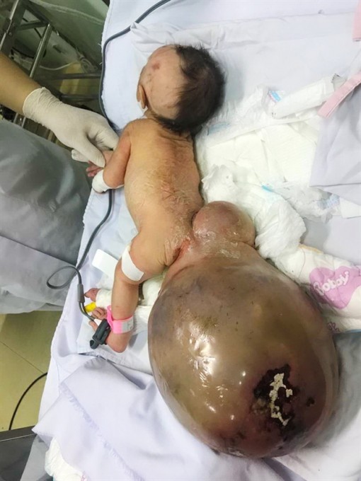 Thai nhi mang bướu khủng: không cần đình chỉ thai kỳ