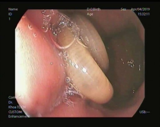 Phát hiện giun đũa dài 15cm trong dạ dày bệnh nhân 65 tuổi