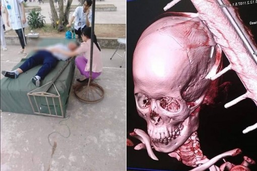 Học nhảy cao, nam sinh lớp 6 bị cọc tự chế cắm vào sọ não