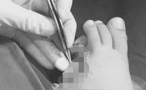 Bé 6 tuổi đứt lìa hai ngón chân vì tấm chắn pô xe máy