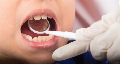 Có phải nong hàm sẽ không cần niềng răng?