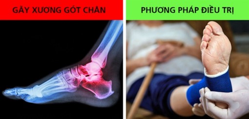 9 cách giảm đau gót chân