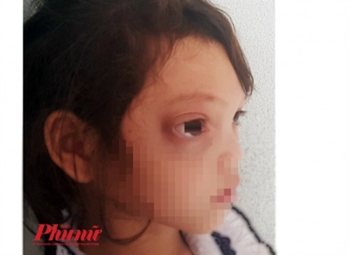 Dân làng ở Quảng Nam tế trâu trị bệnh cho cô bé bị chảy máu mũi liên tục