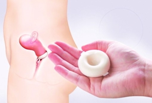 Tránh thai kiểu nào?