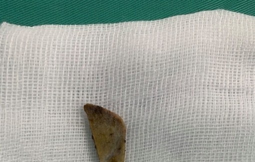 Nuốt mảnh xương vào bụng, người phụ nữ suýt chết khi ăn bún sườn