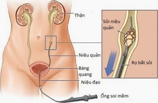 Nang niệu quản bẩm sinh: Phát hiện sớm, tránh biến chứng