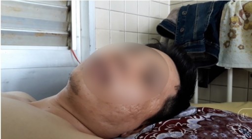 Bệnh viện Chợ Rẫy xác nhận nhầm lẫn khoan cẳng chân cho bệnh nhân gãy đốt sống ngực