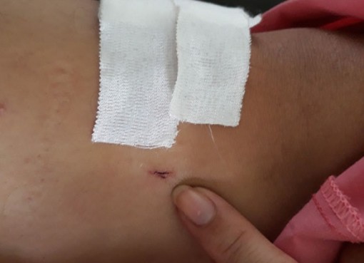 Bệnh viện Chợ Rẫy đình chỉ 2 nhân viên khoan cẳng chân cho bệnh nhân gãy đốt sống ngực