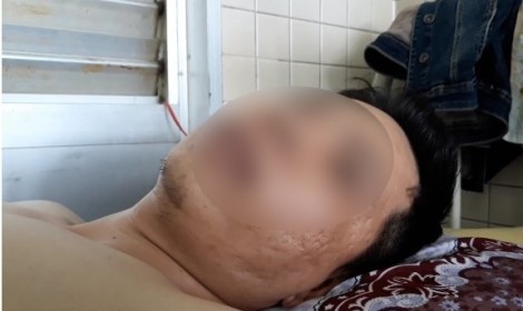 Bệnh viện Chợ Rẫy giải trình về vụ bệnh nhân gãy đốt sống ngực lại bị khoan chân