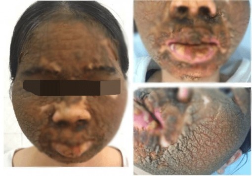 Dùng kem tẩy trắng da, khuôn mặt cô gái hóa 'da cóc'