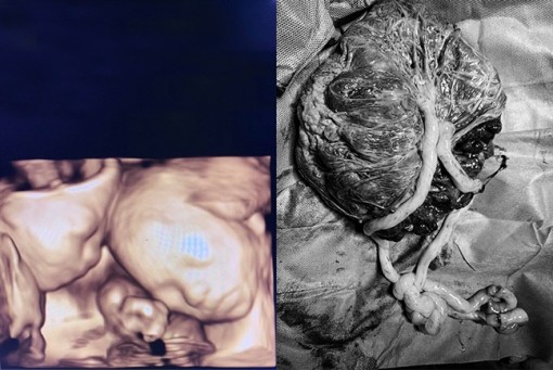 Mổ cứu 2 bé trai song thai 'tam tai' 'độc nhất vô nhị' trong sản khoa Việt Nam