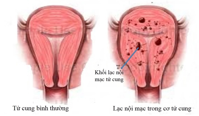 Nhung benh gay kho thu thai o phu nu