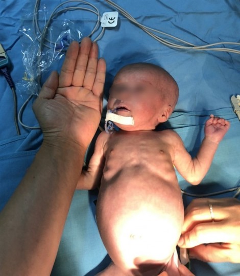 Kỳ diệu: Ca mổ tim cho bé sơ sinh có trái tim chỉ bằng ngón tay cái