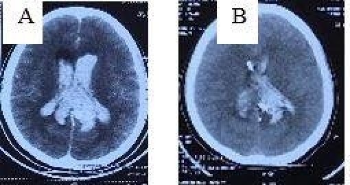 Sau cơn đau đầu, cô gái 18 tuổi đột quỵ não