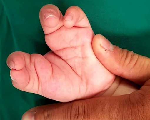 Bác sĩ ‘tặng’ đôi tay mới cho ‘cậu bé càng cua’