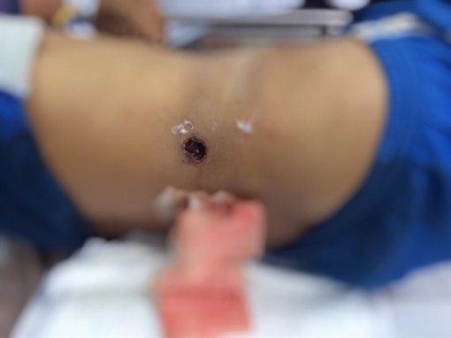 Ôm súng đi săn, nam thanh niên ngã xe máy bị súng bắn thấu bụng