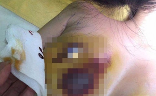 Trốn chồng đi bơm mỡ nâng ngực, mẹ bỉm sữa hoại tử vòng một