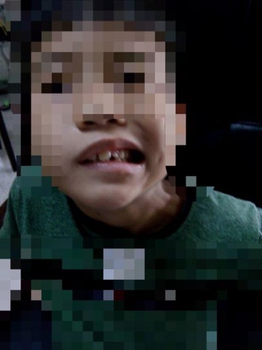 Bé trai 8 tuổi lệch mặt, méo miệng sau một đêm vì sai lầm dễ gặp của cha mẹ