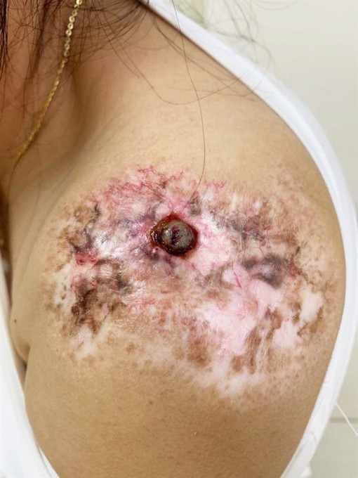 Chấm hóa chất trị sẹo: Hiệu quả ít, hậu quả nhiều