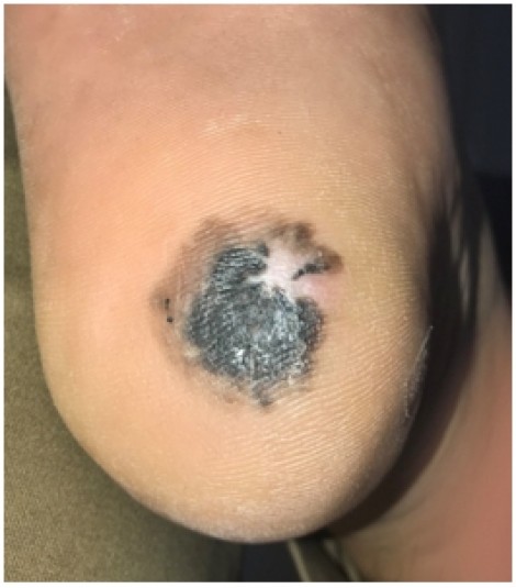 Xuất hiện đốm đen ở gót chân, nam bệnh nhân 'ngã ngửa' phát hiện ung thư da
