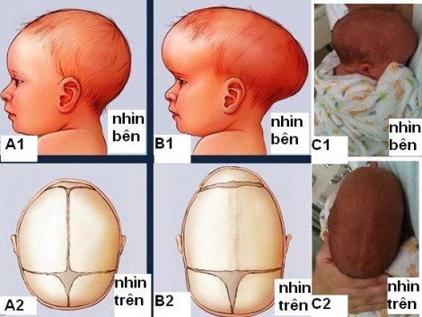 Dị dạng hộp sọ, bé 5 tháng tuổi không ngóc được đầu