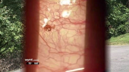 Sửa điện, người đàn ông bị ve cắn chặt vào mắt không nhả