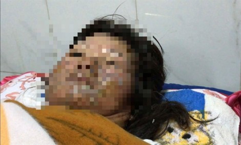 Một phụ nữ bị chồng tẩm xăng đốt, gây bỏng từ mặt xuống đùi