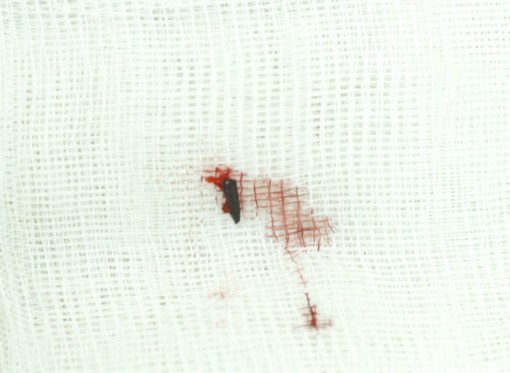 Đầu bút chì nằm 5 năm trong hốc mắt bé gái 13 tuổi