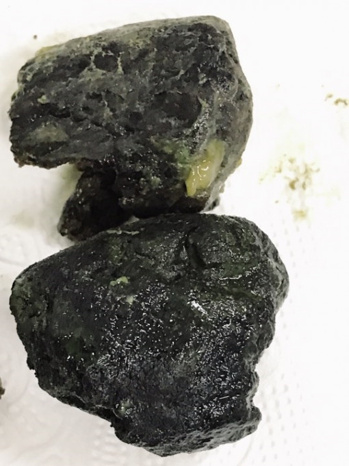 Nam thanh niên tắc ruột do nghiện... trà sữa?