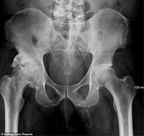 Bác sĩ sốc khi chụp X-quang thấy 'của quý' có xương