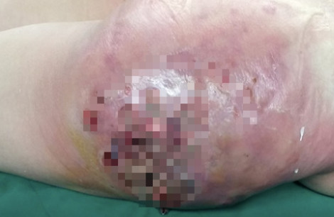 Một phụ nữ bị biến dạng mông sau khi tiêm chất làm đầy kéo dài thanh xuân