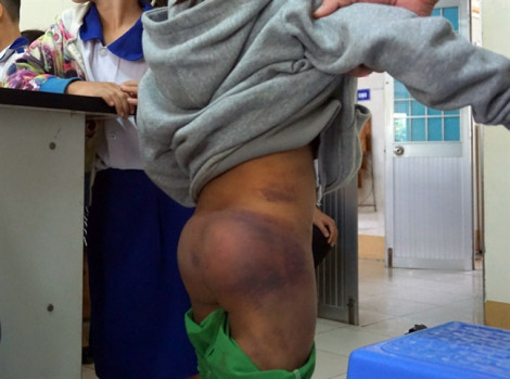 Nghịch nước, 4 cháu nhỏ ở Cà Mau bị bạo hành đến gãy xương mũi