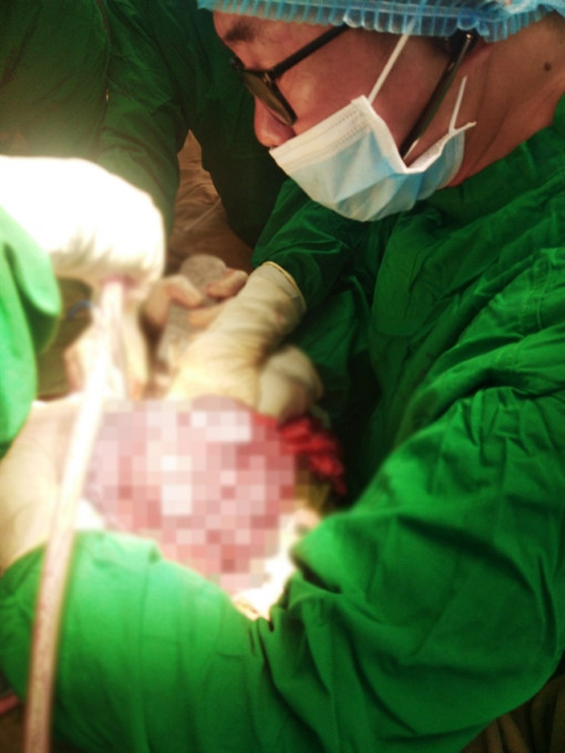 Bác sĩ Sài Gòn phát hiện khối u ở lá lách dài đến nửa mét và nặng hơn 5kg