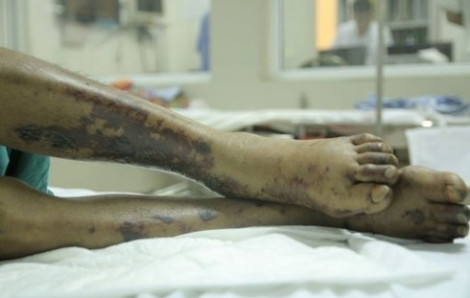 Đứt tay khi xắt thịt heo, người phụ nữ nhiễm liên cầu khuẩn lợn