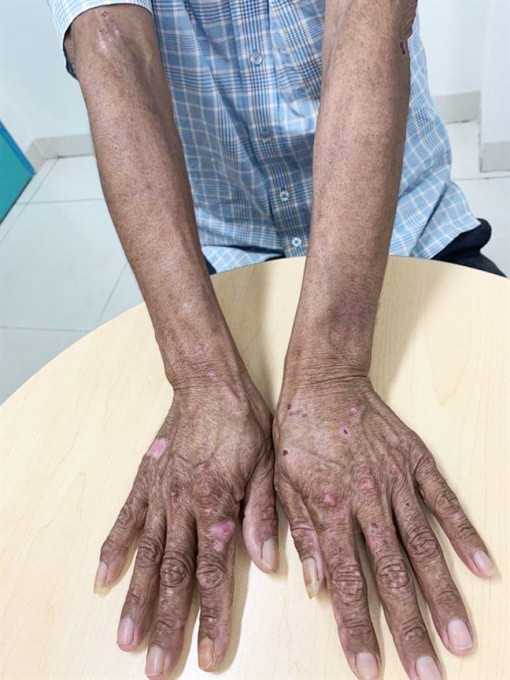 Đi khám da, lòi ra nhiễm độc sắt