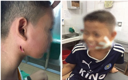 Chữa quai bị tại nhà không khỏi, 3 trẻ nhỏ được phát hiện nhiễm ‘vi khuẩn ăn mòn cơ thể’